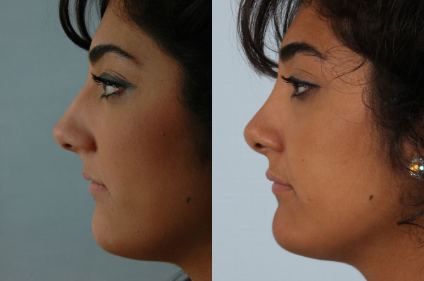 before and after rhinoplasty female patient left side view case 3645