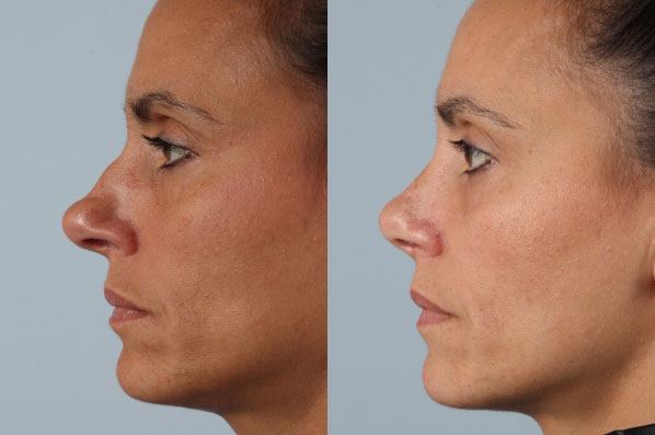 before and after rhinoplasty female patient left side view case 3665