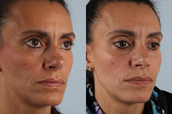 before and after rhinoplasty female patient left diagonal view case 3665