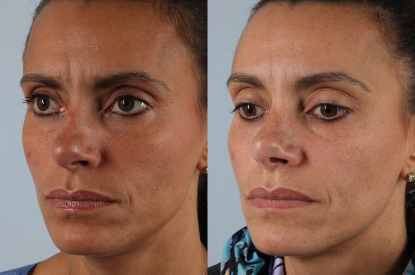 before and after rhinoplasty female patient left diagonal view case 3665