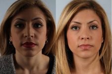 before and after rhinoplasty female patient front view case 3687