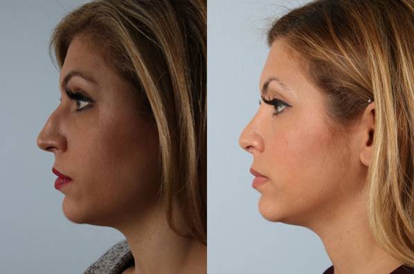 before and after rhinoplasty female patient left side view case 3687