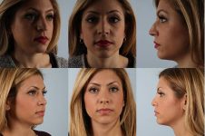 before and after rhinoplasty female patient multiple angle view case 3687