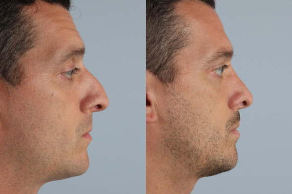 before and after rhinoplasty male patient right side view case 3702