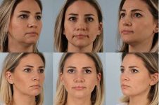 before and after rhinoplasty female patient multiple angle view case 3735