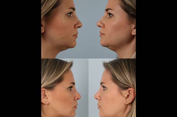 before and after rhinoplasty female patient left and right side view case 3735