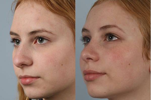 before and after rhinoplasty female patient left diagonal view case 3740