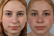 before and after rhinoplasty female patient front view case 3740