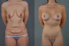 before and after total body lift female patient front view case 3059
