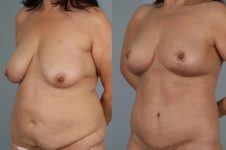 before and after total body lift female patient left diagonal view case 3050