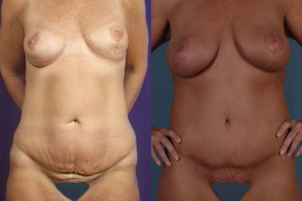 before and after total body lift female patient front view case 3045