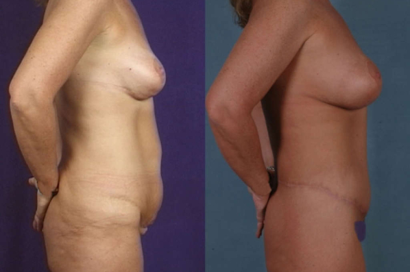 before and after total body lift female patient right side view case 3045