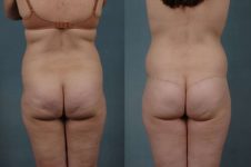 before and after total body lift female patient back view case 3031