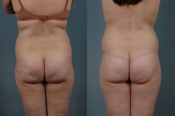 before and after total body lift female patient back view case 3031