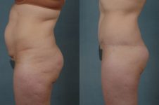 before and after total body lift female patient left side view case 3031