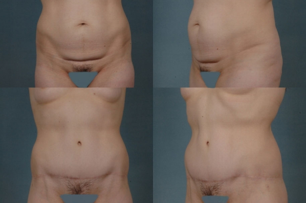 before and after total body lift female patient multiple angle view case 3031