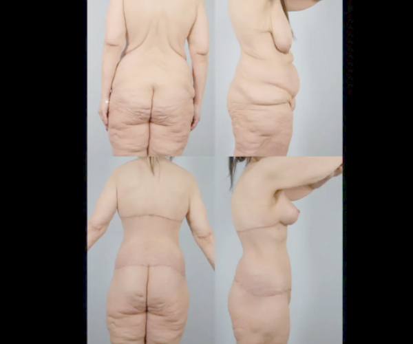 before and after total body lift female patient multiple view case 3035