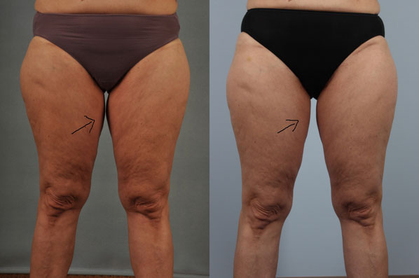 before and after coolsculpting female patient inner thighs front view