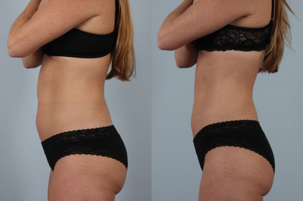 before and after coolsculpting female patient left side view