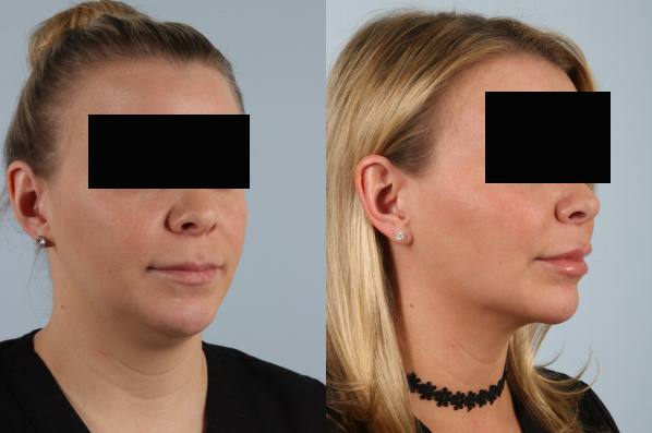 before and after facelift SMAS composite (deep plane) female patient right diagonal view case 5378