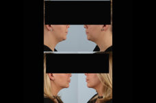 before and after facelift SMAS composite (deep plane) female patient left and right side view case 5378