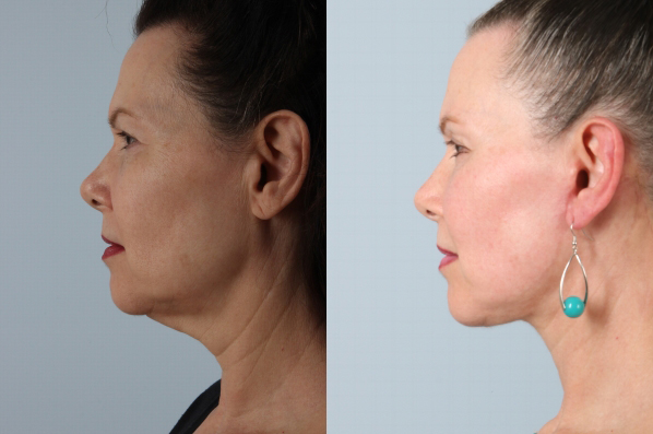before and after facelift SMAS composite (deep plane) female patient left side view case 5383