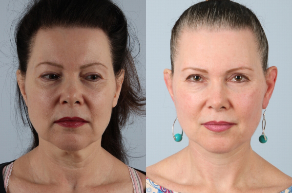 before and after facelift SMAS composite (deep plane) female patient front view case 5383