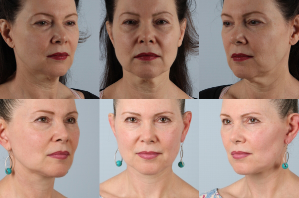 before and after facelift SMAS composite (deep plane) female patient multiple angle view case 5383