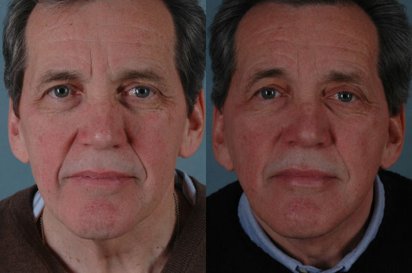 before and after facelift SMAS composite (deep plane) male patient front view case 5391