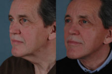 before and after facelift SMAS composite (deep plane) male patient left diagonal view case 5391