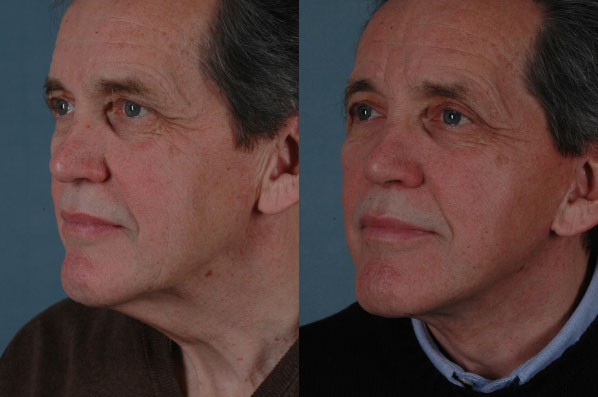 before and after facelift SMAS composite (deep plane) male patient left diagonal view case 5391