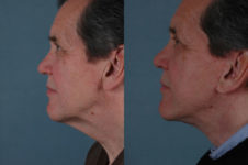 before and after facelift SMAS composite (deep plane) male patient left side view case 5391