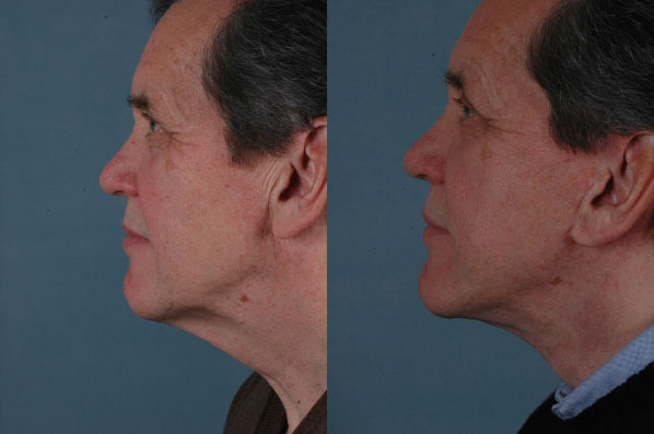before and after facelift SMAS composite (deep plane) male patient left side view case 5391