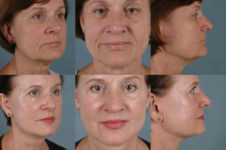 before and after facelift SMAS composite (deep plane) female patient multiple angle view case 5399