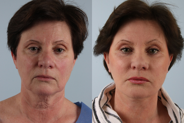 before and after facelift SMAS composite (deep plane) female patient front view case 5413