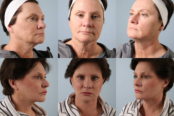 before and after facelift SMAS composite (deep plane) female patient multiple angle view case 5413