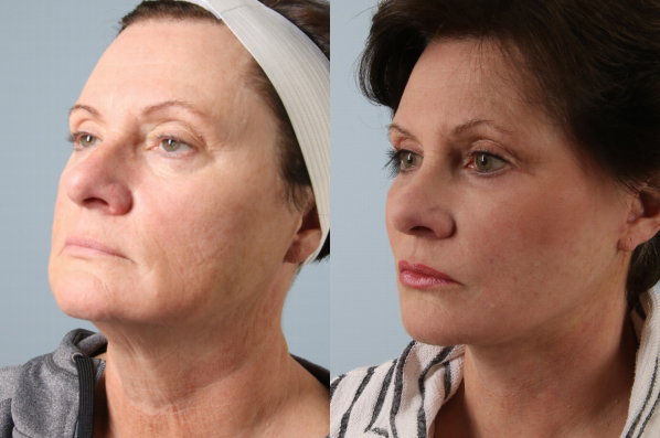 before and after facelift SMAS composite (deep plane) female patient left diagonal view case 5413