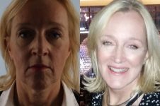 before and after facelift SMAS composite (deep plane) female patient front view case 5441