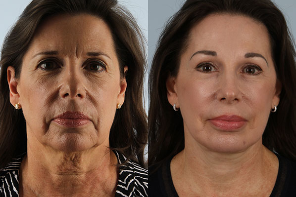 before and after facelift SMAS composite (deep plane) female patient front view case 5444