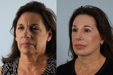 before and after facelift SMAS composite (deep plane) female patient left diagonal view case 5444