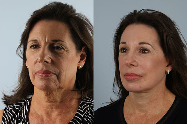 before and after facelift SMAS composite (deep plane) female patient left diagonal view case 5444