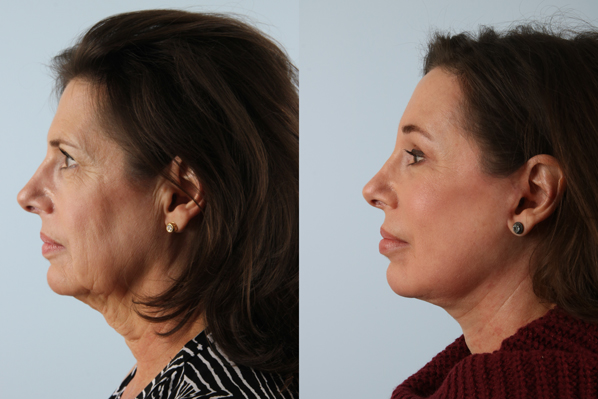 before and after facelift SMAS composite (deep plane) female patient left side view case 5444