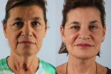 before and after facelift SMAS composite (deep plane) female patient front view case 5449