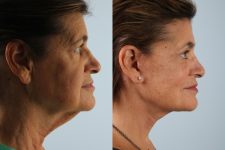 before and after facelift SMAS composite (deep plane) female patient right side view case 5449