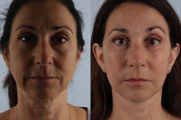 before and after facelift SMAS composite (deep plane) female patient front view case 5454