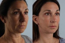 before and after facelift SMAS composite (deep plane) female patient right diagonal view case 5454