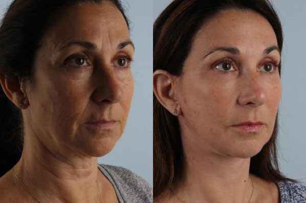 before and after facelift SMAS composite (deep plane) female patient right diagonal view case 5454