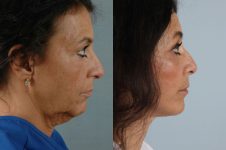 before and after facelift SMAS composite (deep plane) female patient right side view case 5458