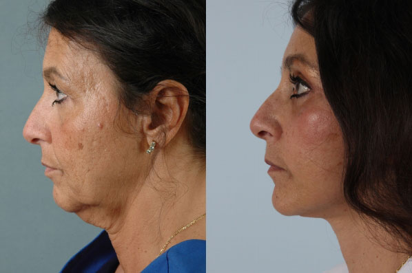 before and after facelift SMAS composite (deep plane) female patient left side view case 5458