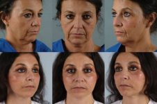 before and after facelift SMAS composite (deep plane) female patient multiple angle view case 5458